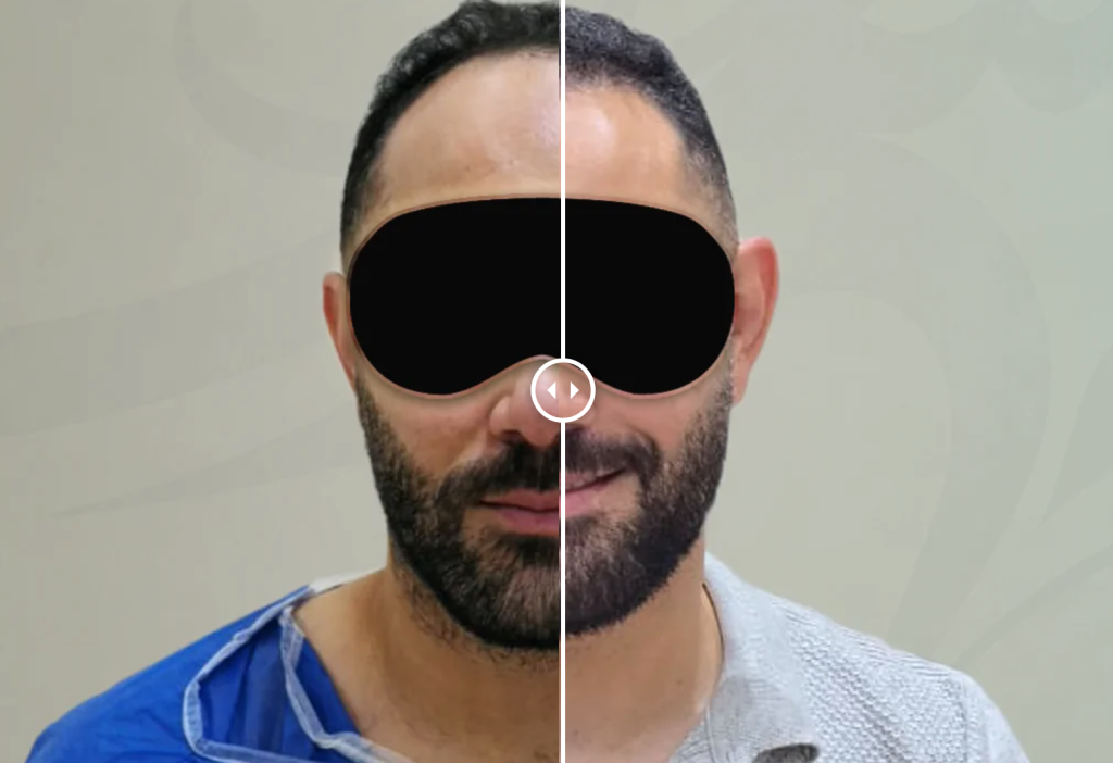 علاج الصلع من الدرجة الثالثة بالميجا سيشن