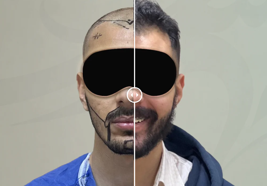 نتائج زراعة الشعر واللحية بعد 6 أشهر