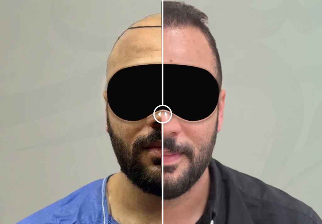 نتيجة زراعة 7100 جرافت بعد 6 أشهر
